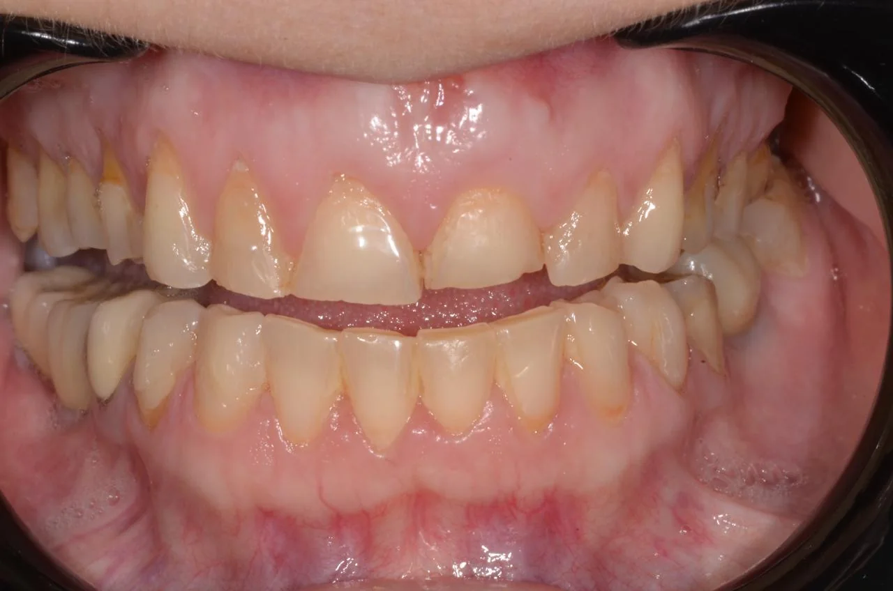 Vista frontal de los dientes con la boca abierta, antes