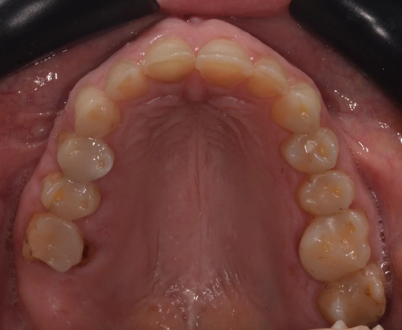 Vista oclusal superior, antes