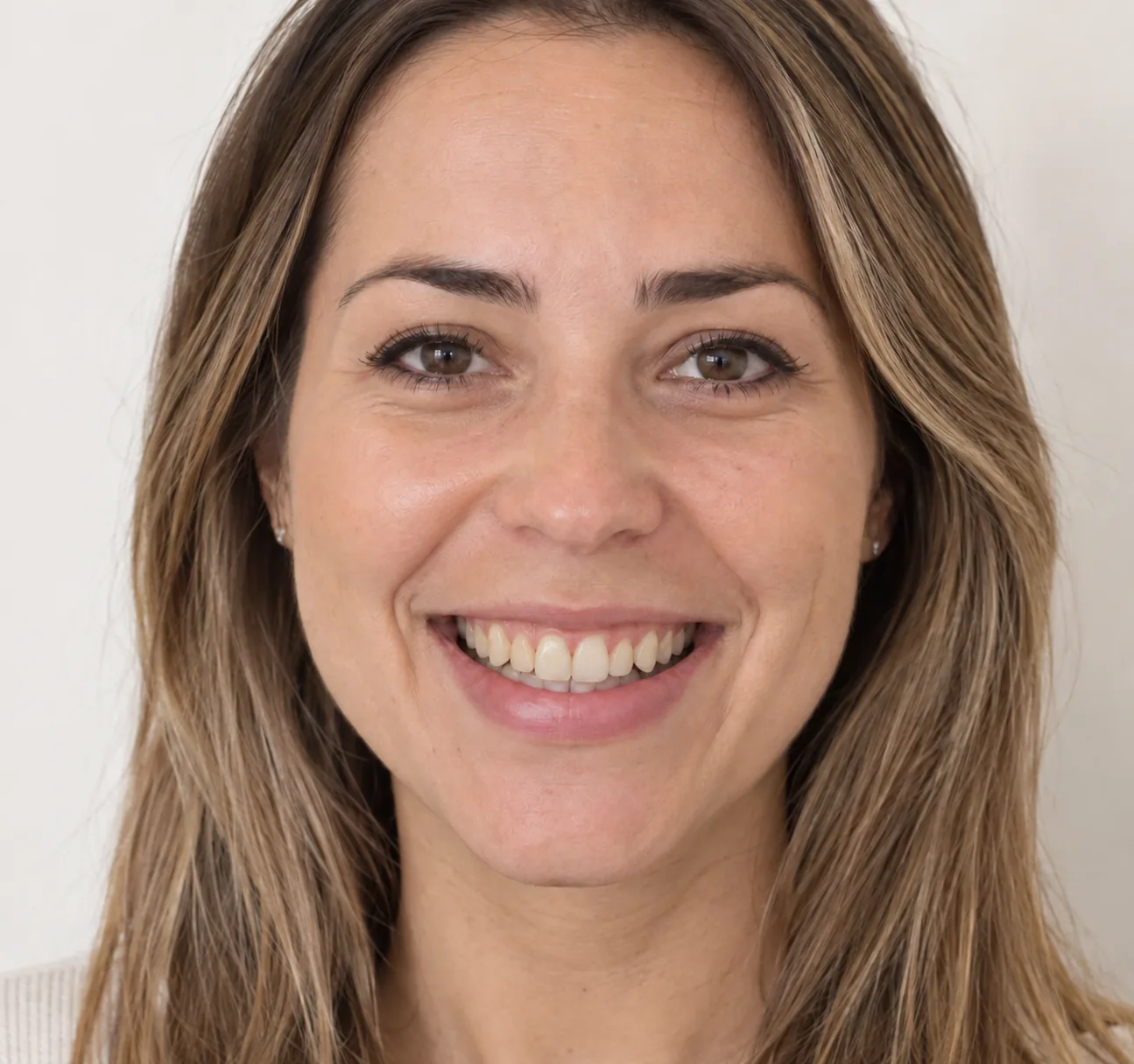Apiñamiento dental