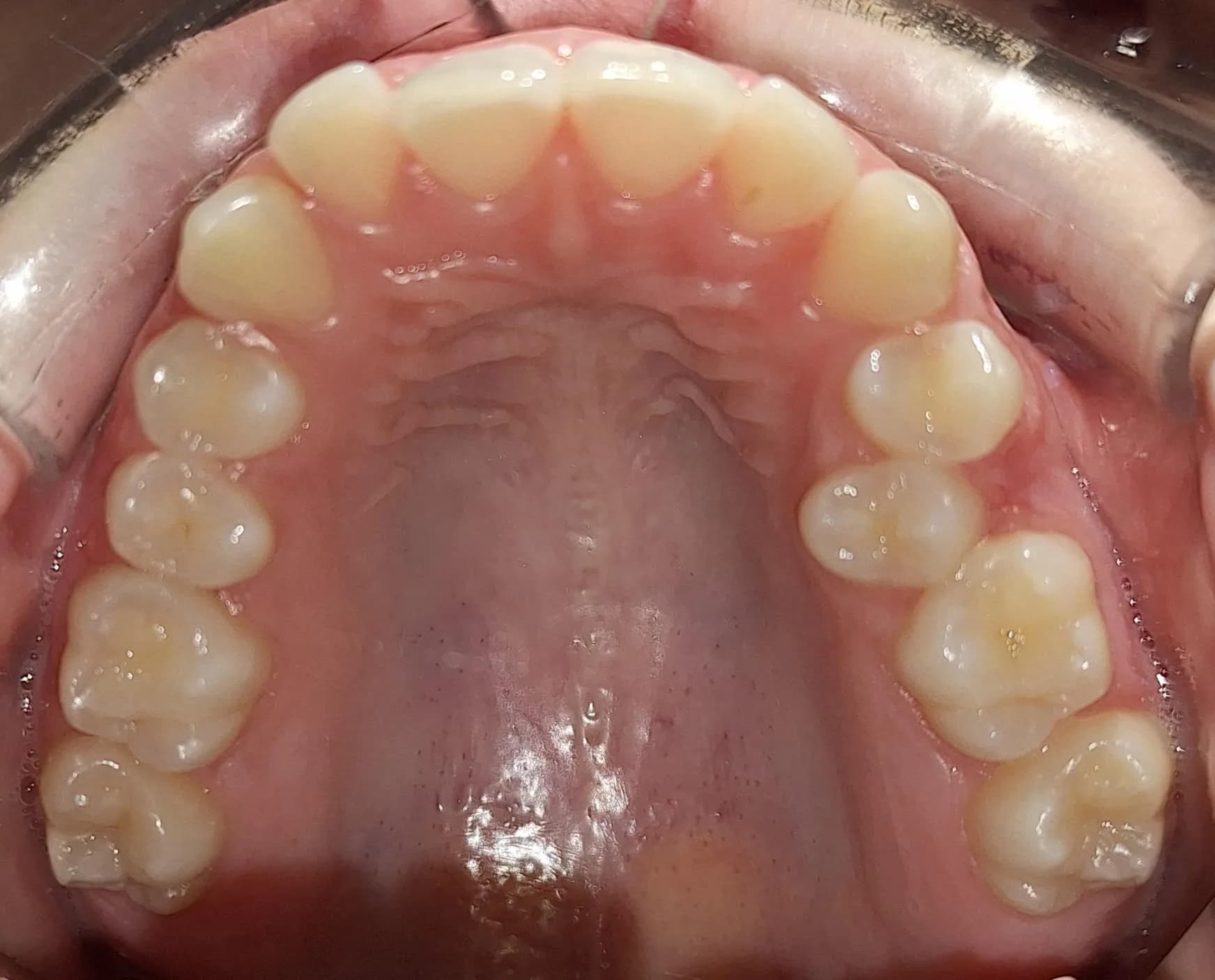 Evolución de la arcada dental, antes