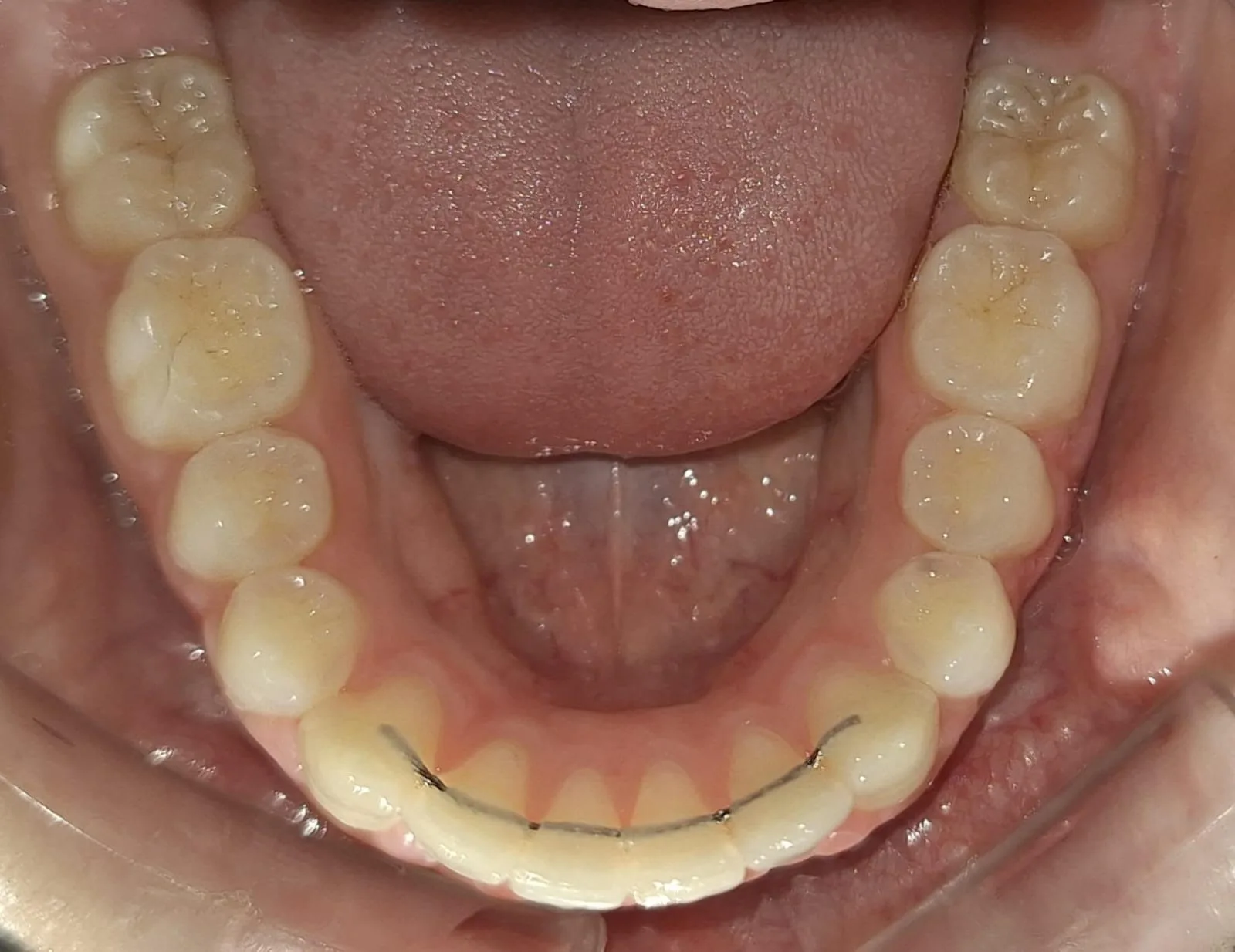 Vista oclusal inferior