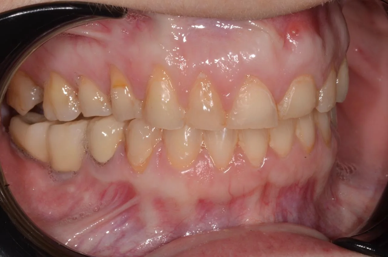 Otra vista frontal de los dientes, antes