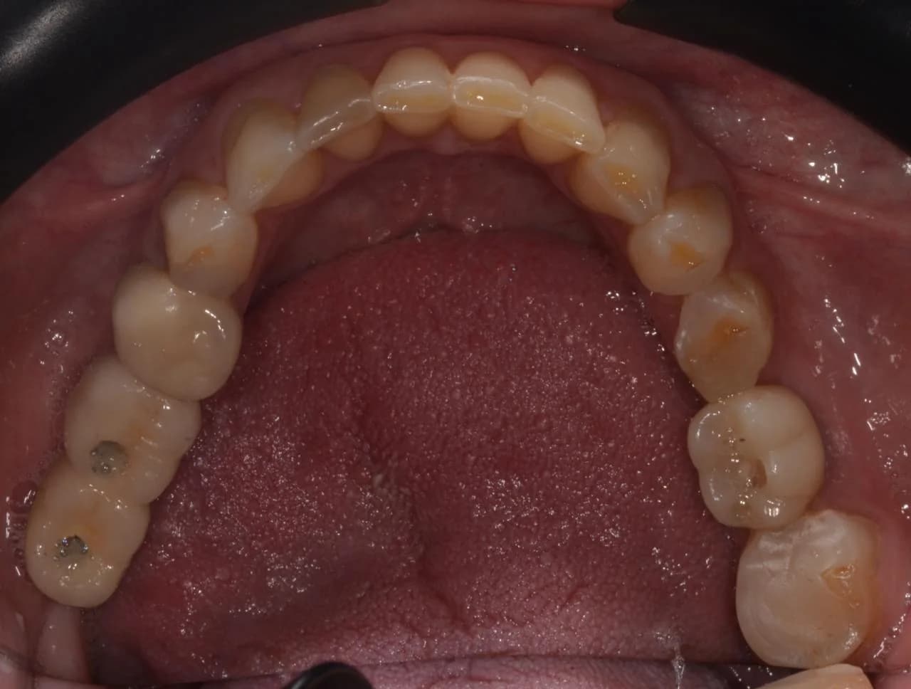 Vista oclusal inferior, antes