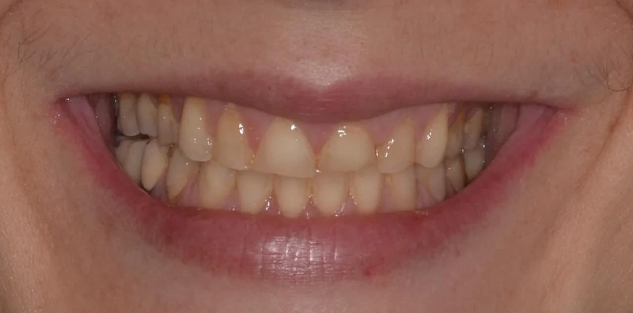Fotografía de la sonrisa, antes