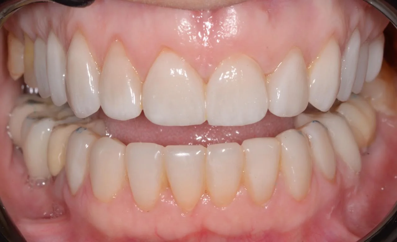 Vista frontal de los dientes con la boca abierta, después