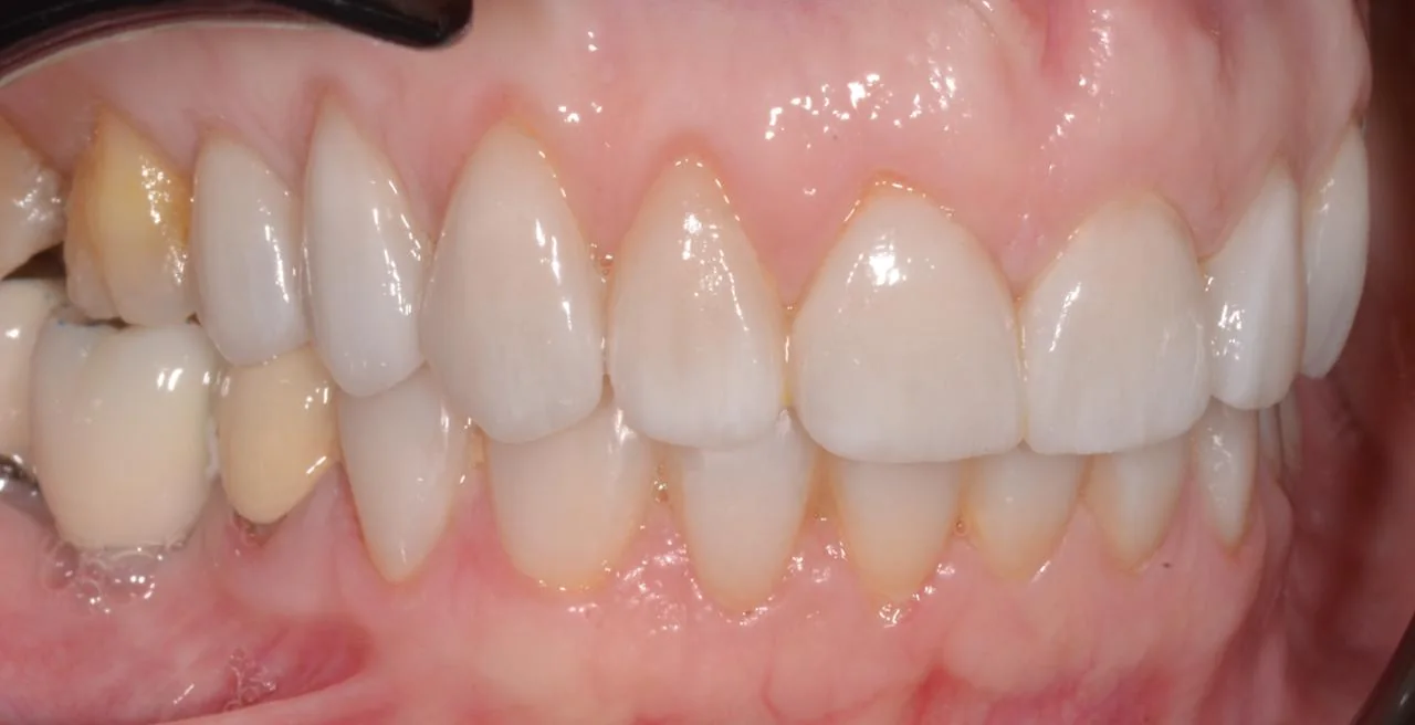 Otra vista frontal de los dientes, después