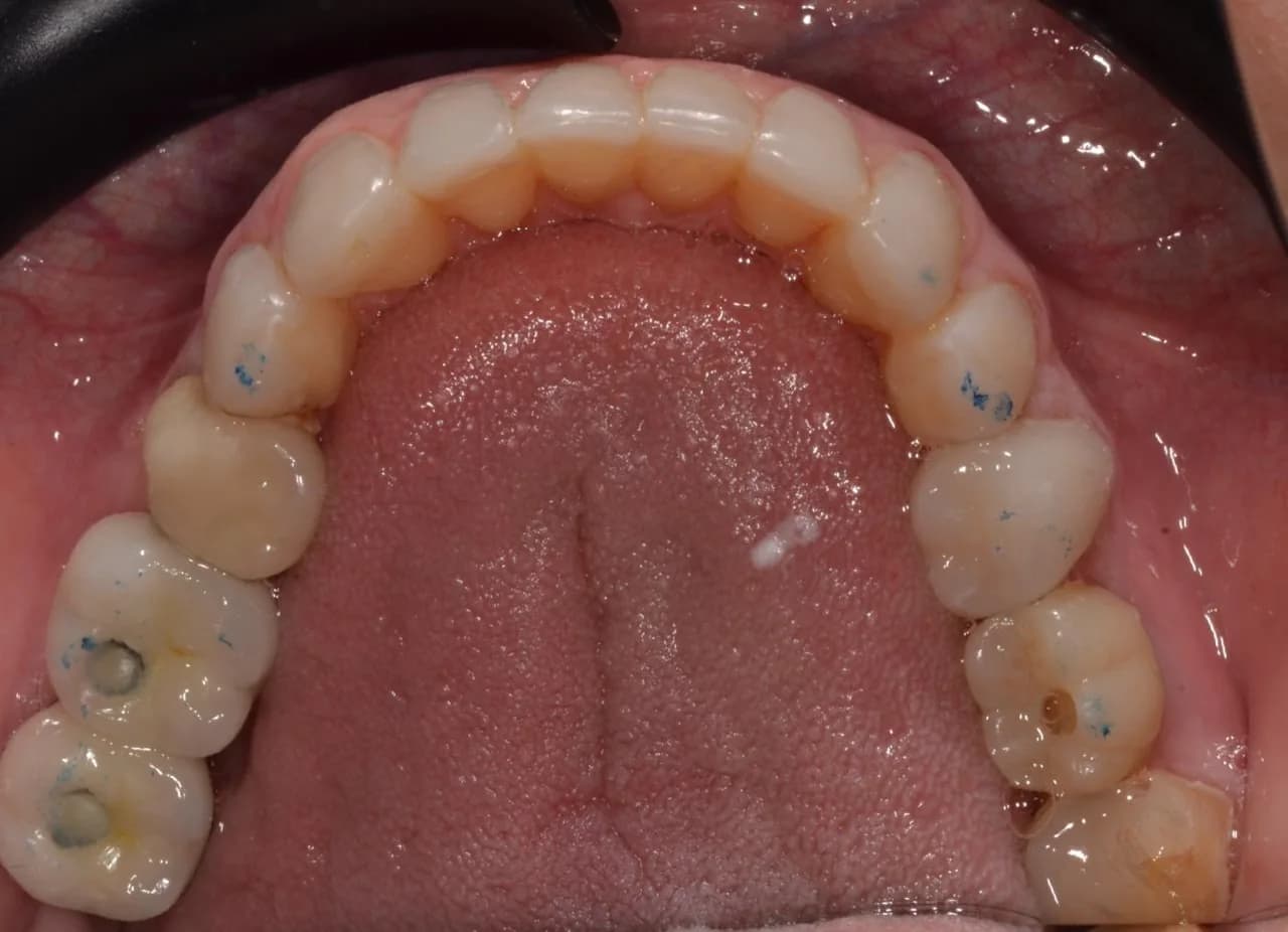 Vista oclusal inferior, después