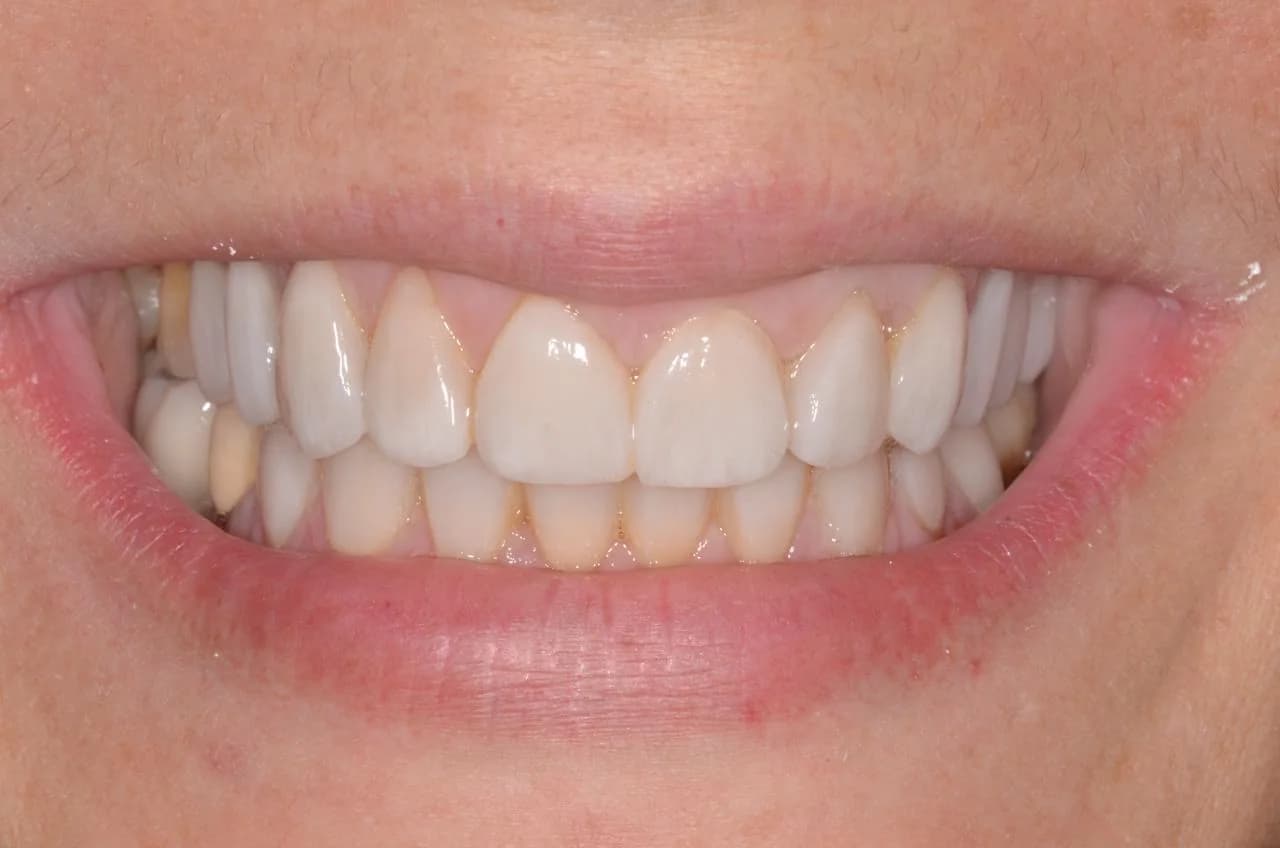 Fotografía de la sonrisa, después