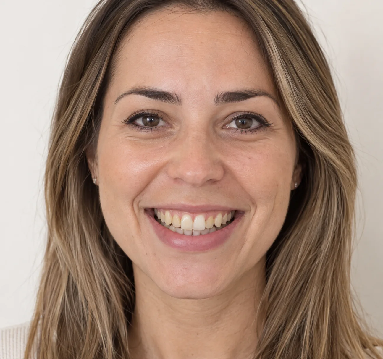 Sonrisa antes y después del tratamiento de ortodoncia, antes